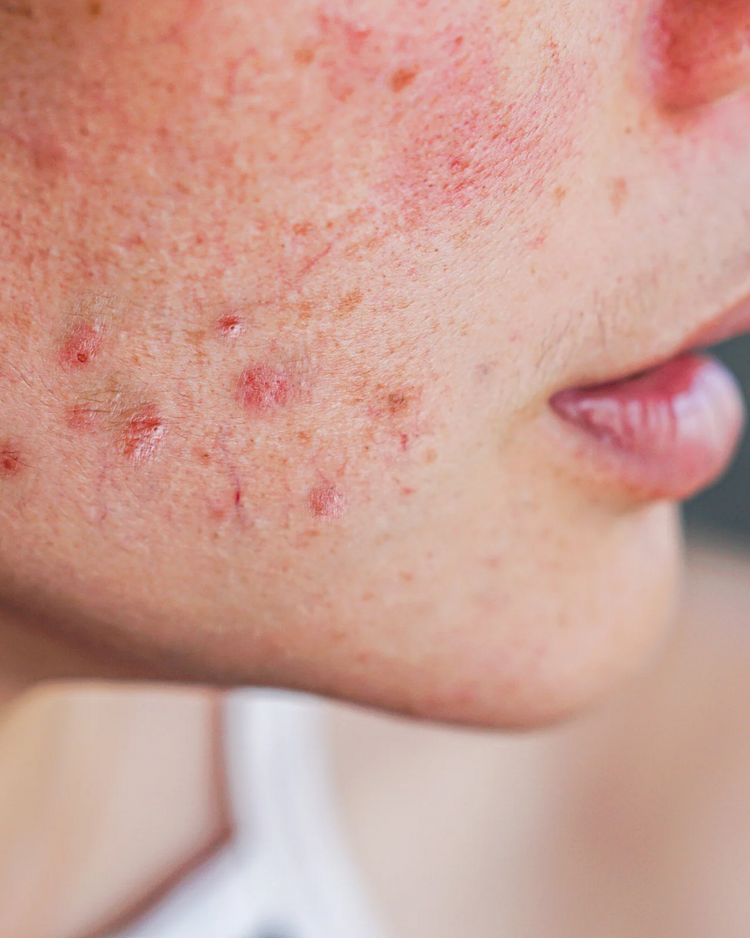 Acne