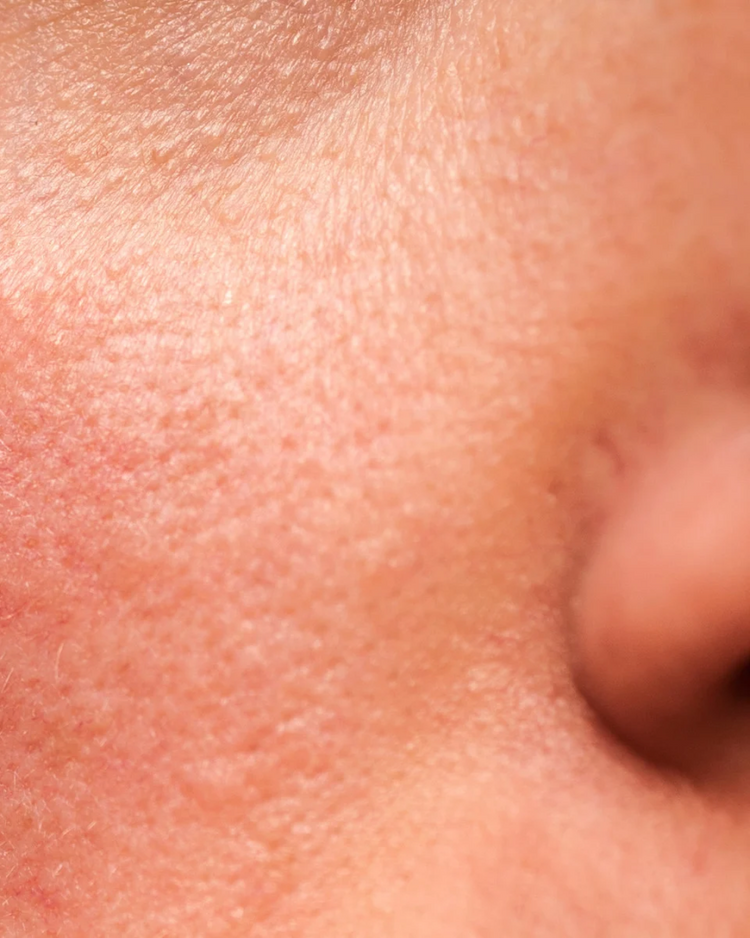 Redness / Inflammation