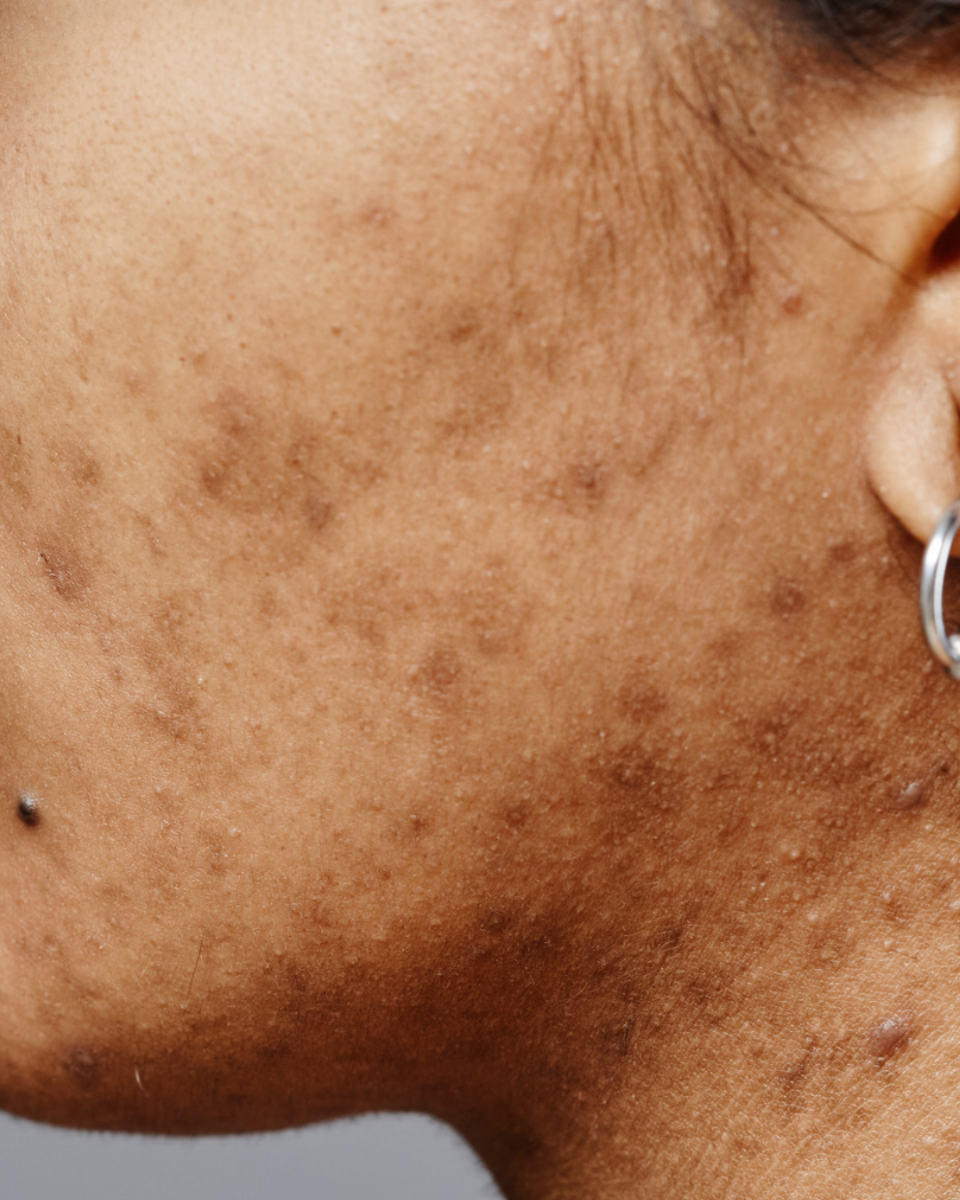 Dullness / Pigmentation